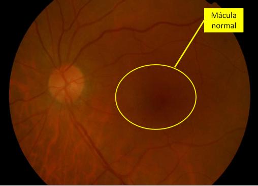 retina con macula normal