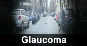 Glaucoma y conducción